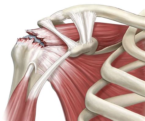 rotator cuff torn shoulder